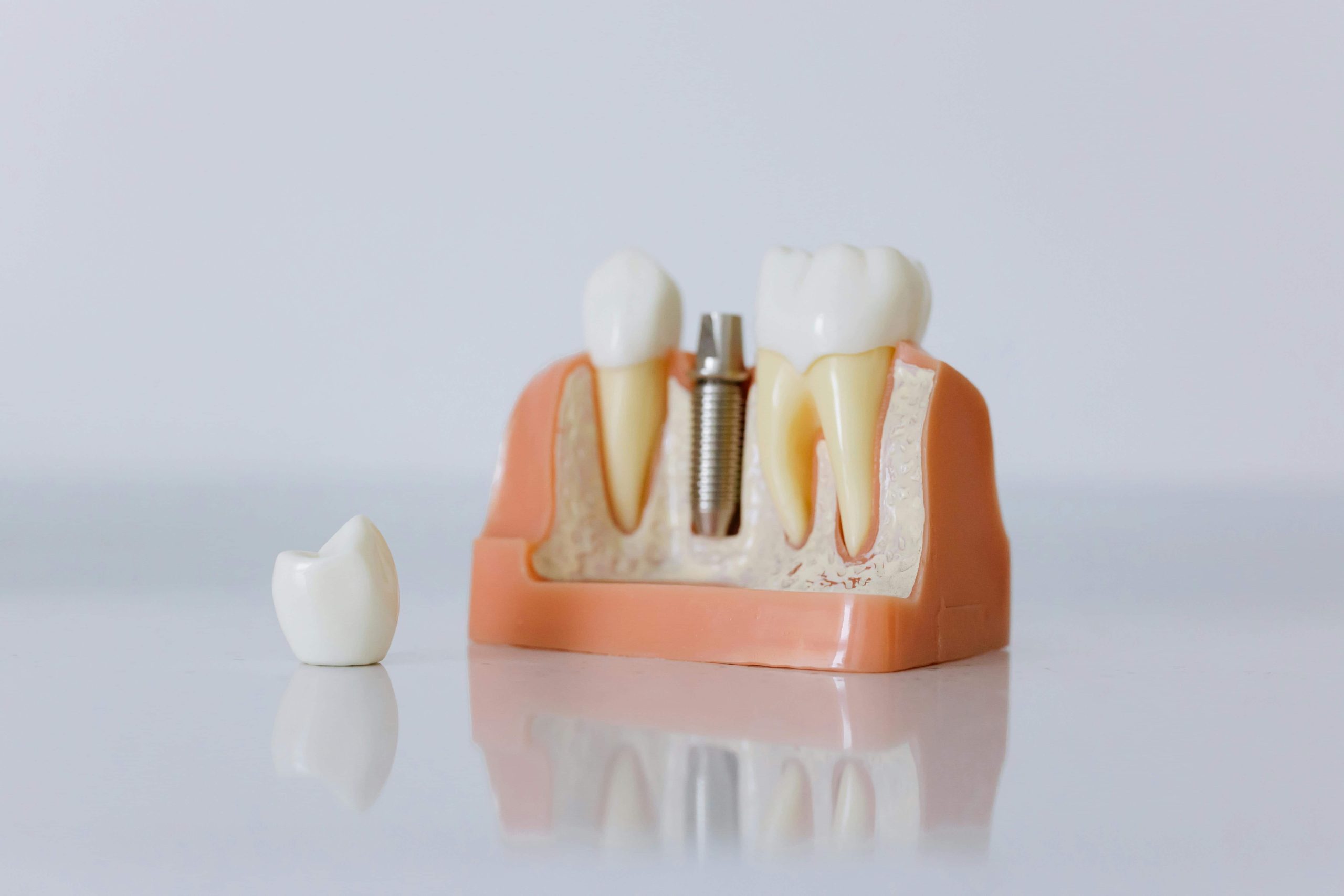 What to Know Before Getting Dental Implants in Mackay