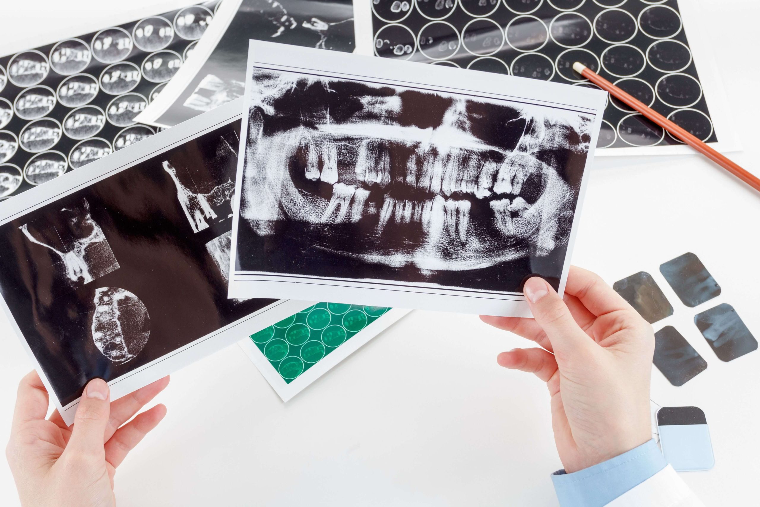 What Happens During a Sedated Wisdom Tooth Extraction